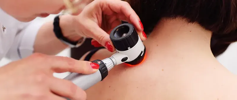 Badanie znamienia na karku dermatoskopem