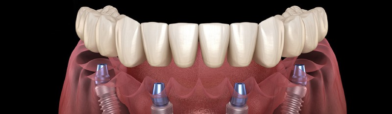 Proteza na implantach