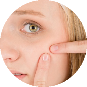 Przyczyny trądziku a jego zwalczanie