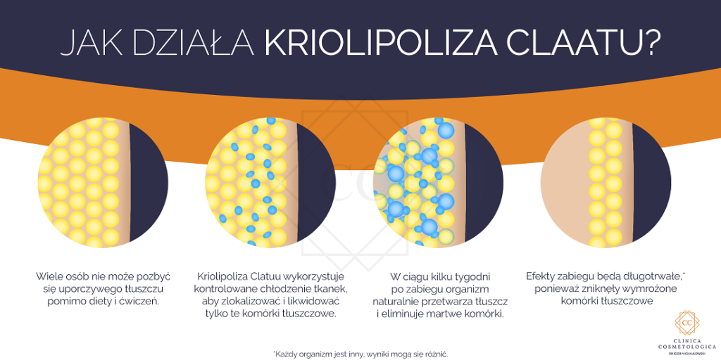 kriolipoliza dzialanie