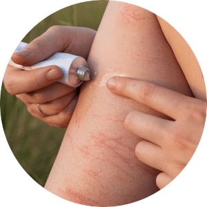 Krem na blizny warto stosować